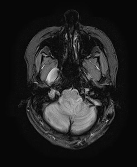 File:Neurofibromatosis type 2 (Radiopaedia 66211-75401 Axial Gradient Echo 8).jpg