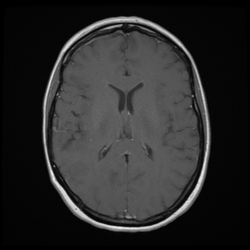 File:Neurofibromatosis type 2 - bilateral acoustic neuromata (Radiopaedia 40060-42566 Axial T1 C+ 12).png