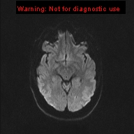 File:Neuroglial cyst (Radiopaedia 10713-11184 Axial DWI 36).jpg