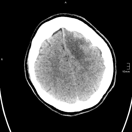 File:Neurotoxoplasmosis - concentric target sign (Radiopaedia 70644-80783 Axial non-contrast 30).jpg