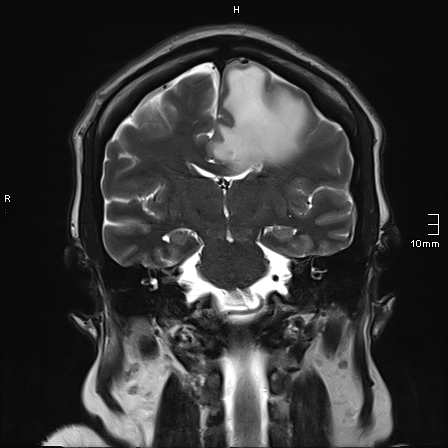 File:Neurotoxoplasmosis - concentric target sign (Radiopaedia 70644-80784 Coronal T2 22).jpg