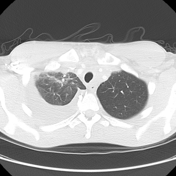 File:Non-Hodgkin lymphoma involving lung (Radiopaedia 29094-29470 Axial lung window 16).jpg