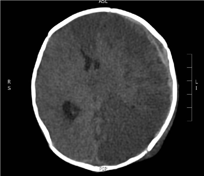 File:Non-accidental injury - intracranial injuries and skull fracture (Radiopaedia 17753-17508 Axial non-contrast 1).jpg