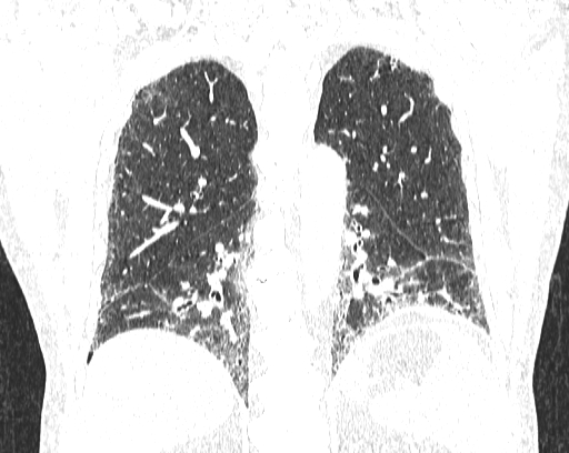 Non-specific interstitial pneumonia (NSIP) (Radiopaedia 68599-78228 Coronal lung window 67).jpg