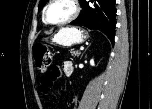 Non-syndromic pancreatic endocrine tumor (Radiopaedia 86958-103178 E 69).jpg