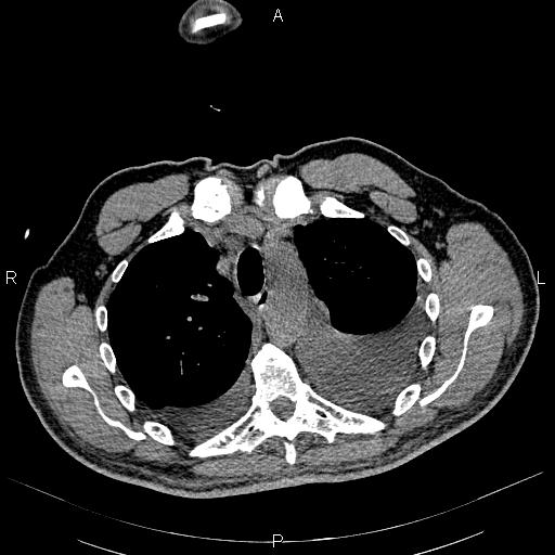 File:Non Hodgkin lymphoma in a patient with ankylosing spondylitis (Radiopaedia 84323-99621 Axial non-contrast 8).jpg