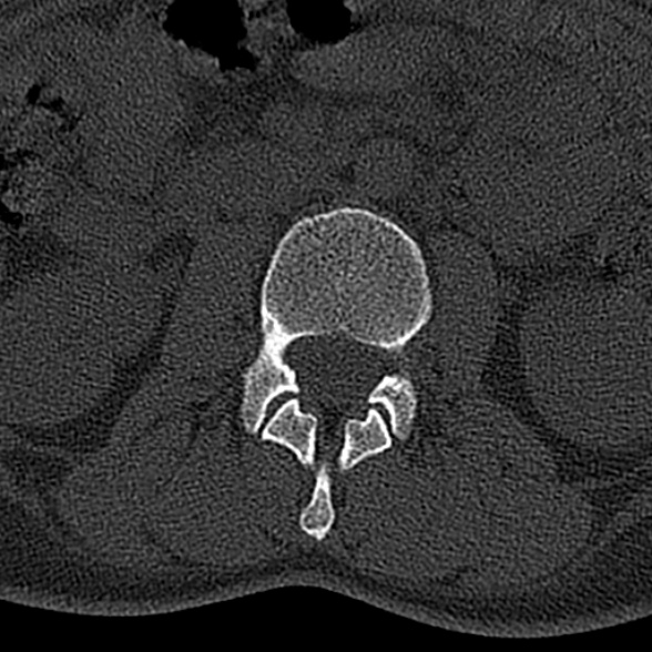 File:Normal CT lumbar spine (Radiopaedia 53981-60118 Axial bone window 31).jpg