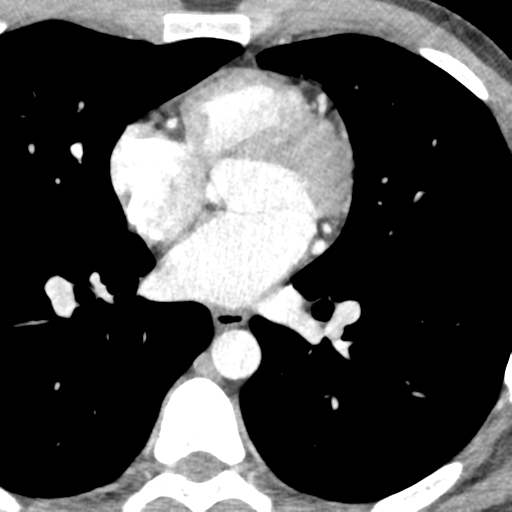 File:Normal CT pulmonary veins (pre RF ablation) (Radiopaedia 41748-44702 A 170).png