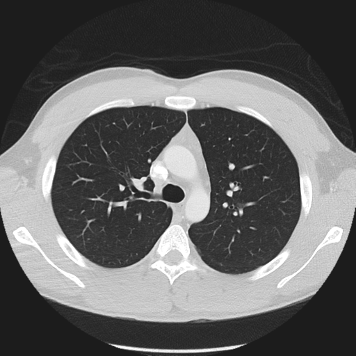 Normal CT pulmonary veins (pre RF ablation) (Radiopaedia 41748-44702 Axial lung window 4).png