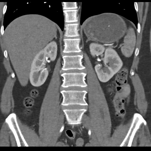 File:Normal CT renal artery angiogram (Radiopaedia 38727-40889 B 47).png