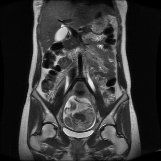 File:Normal MRI abdomen in pregnancy (Radiopaedia 88001-104541 Coronal T2 16).jpg