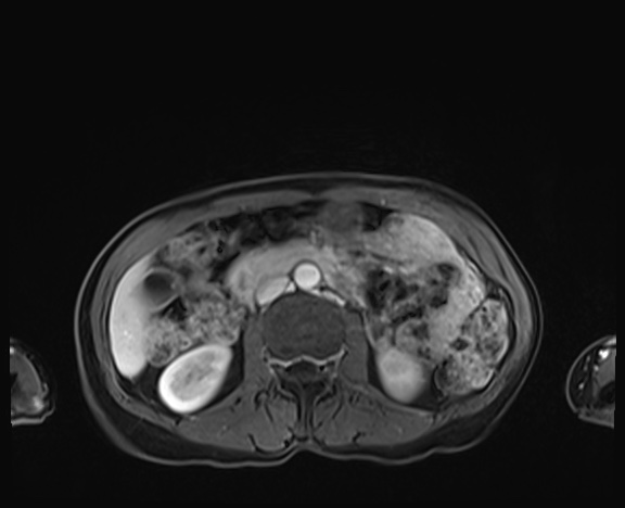 Normal adrenal glands MRI (Radiopaedia 82017-96004 K 47).jpg