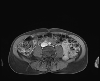 Normal adrenal glands MRI (Radiopaedia 82017-96004 M 68).jpg