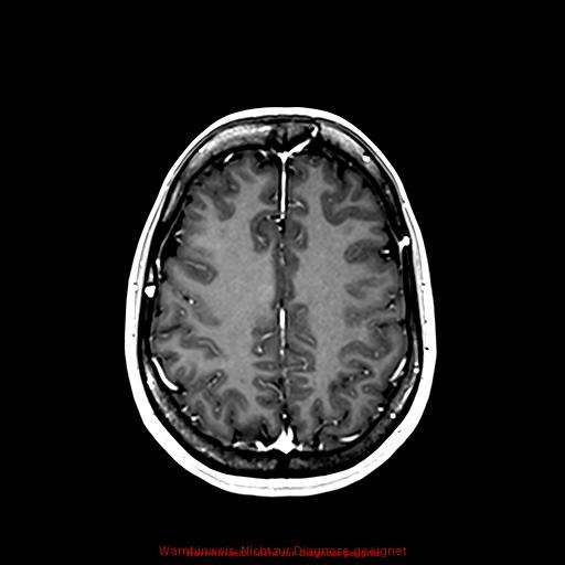 Normal adult brain MRI (non-enhanced and contrast-enhanced) (Radiopaedia 75262-86379 Axial T1 C+ 135).jpg