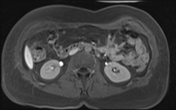 File:Normal hepatobiliary phase liver MRI (Radiopaedia 58968-66230 A 69).jpg