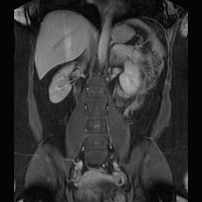 Normal liver MRI with Gadolinium (Radiopaedia 58913-66163 P 52).jpg