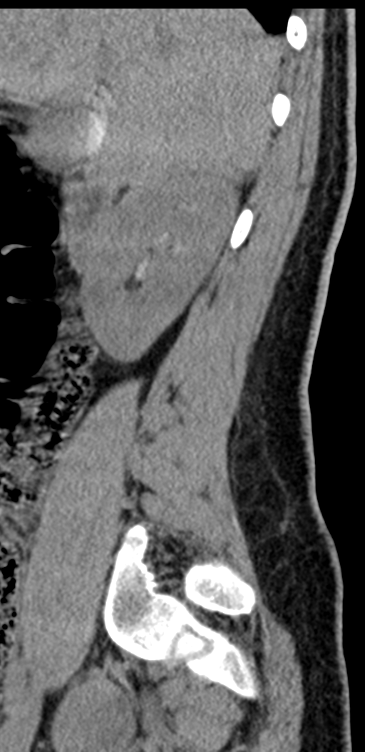 Normal lumbosacral CT (Radiopaedia 37923-39867 E 90).png