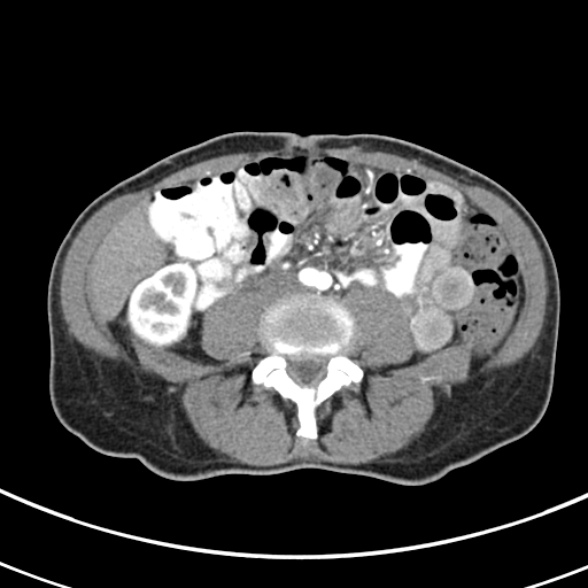 File:Normal multiphase CT liver (Radiopaedia 38026-39996 B 53).jpg