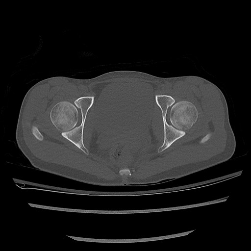 Normal pelvis CT (Radiopaedia 51471-57236 Axial bone window 74).jpg