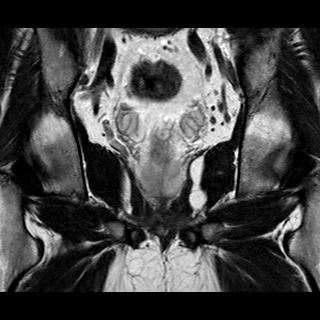 File:Normal prostate (MRI) (Radiopaedia 29986-30535 Coronal T2 14).jpg