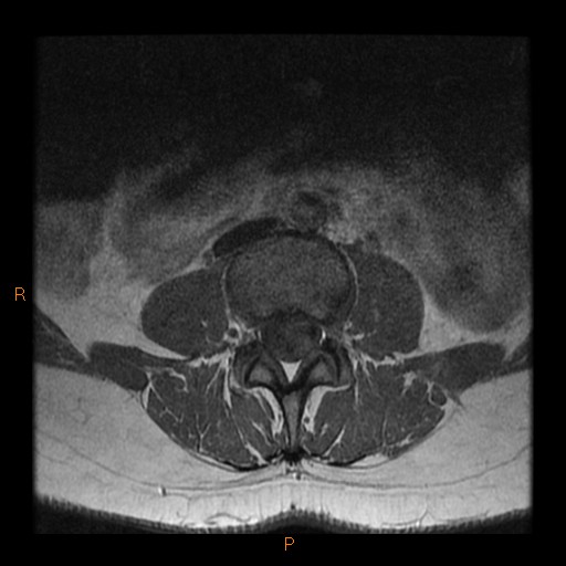 File:Normal spine MRI (Radiopaedia 77323-89408 Axial T1 8).jpg