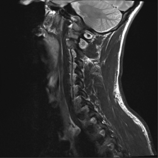 File:Normal trauma cervical spine (Radiopaedia 41017-43762 Sagittal T2 13).png