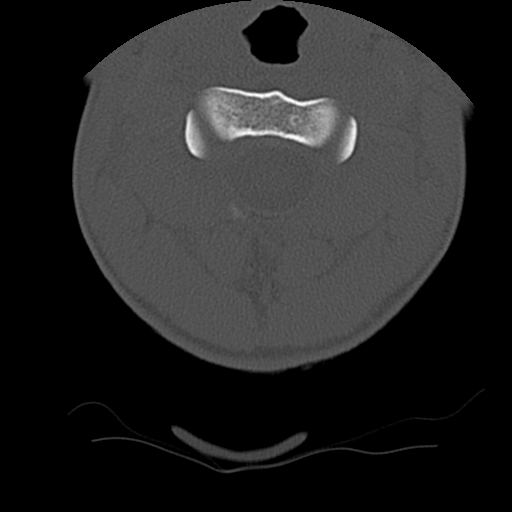 File:Normal trauma spine imaging (age 16) (Radiopaedia 45335-49358 Axial bone window 16).jpg
