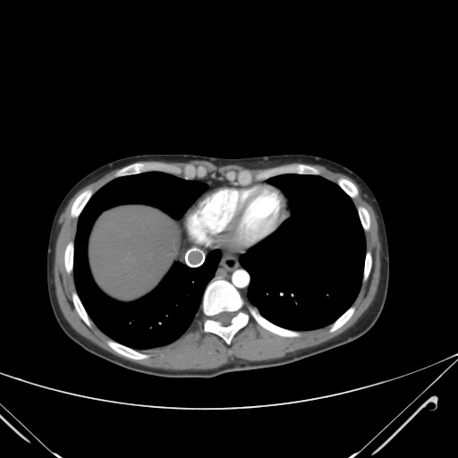 File:Nutmeg liver- Budd-Chiari syndrome (Radiopaedia 46234-50635 A 5).png