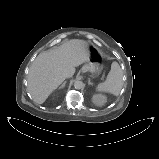File:Obstructive pyelonephritis (Radiopaedia 46411-50844 Axial non-contrast 20).png