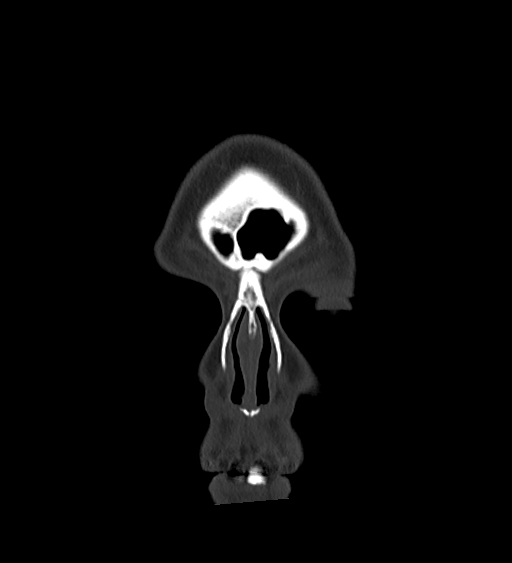 Occipital spur and Currarino type A atlas anomaly (Radiopaedia 87027-103285 Coronal bone window 24).jpg