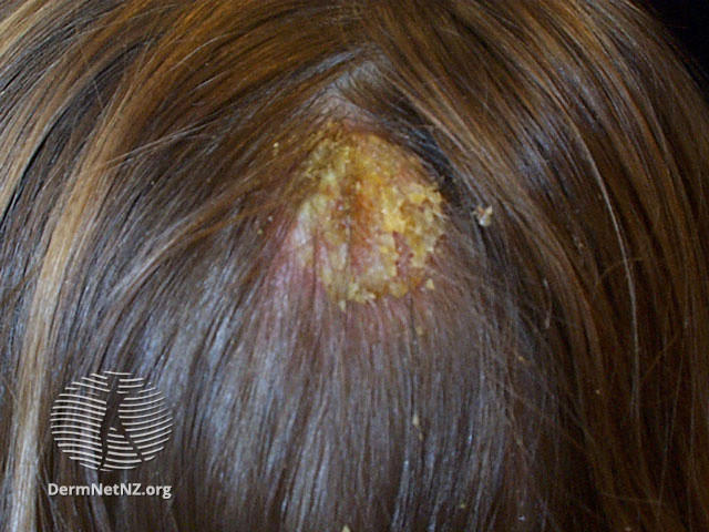 File:Seborrhoeic dermatitis (DermNet NZ hair-nails-sweat-sebderm-scalp).jpg
