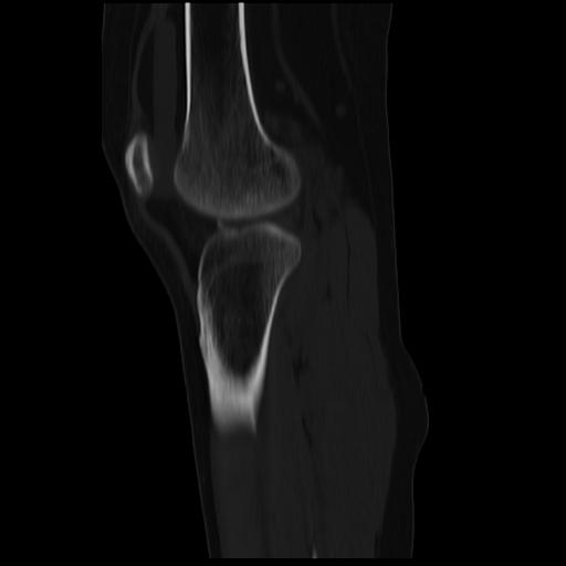 File:ACL avulsion fracture (Radiopaedia 33833-34994 Sagittal bone window 17).jpg