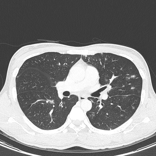 File:AIDS-related Kaposi sarcoma (Radiopaedia 85247-100811 Axial lung window 76).jpg