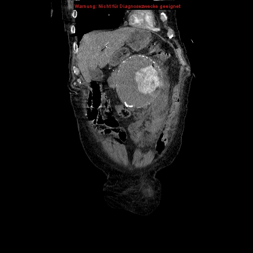File:Abdominal aortic aneurysm- extremely large, ruptured (Radiopaedia 19882-19921 Coronal C+ arterial phase 23).jpg
