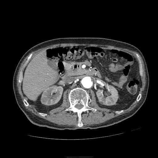 Abdominal aortic aneurysm (Radiopaedia 13341-13340 Axial C+ arterial phase 73).jpg
