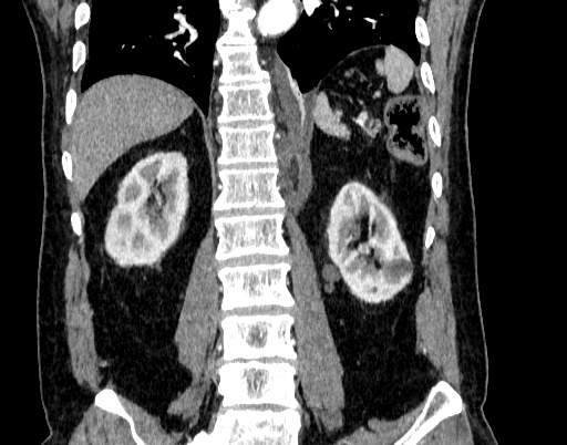 File:Abdominal aortic aneurysm (Radiopaedia 67117-76452 Coronal C+ arterial phase 75).jpg