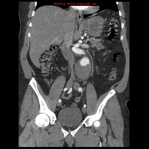 Abdominal aortic aneurysm (Radiopaedia 8190-9038 Coronal C+ arterial phase 65).jpg