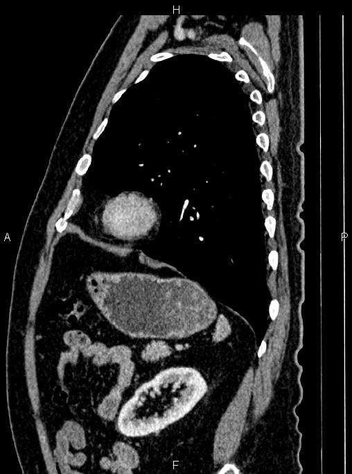 Abdominal aortic aneurysm (Radiopaedia 83094-97462 Sagittal renal cortical phase 91).jpg