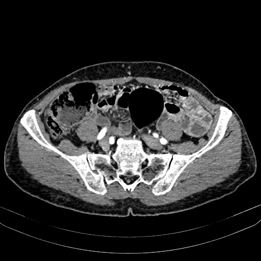 Abdominal aortic aneurysm (Radiopaedia 83581-98689 Axial C+ arterial phase 87).jpg