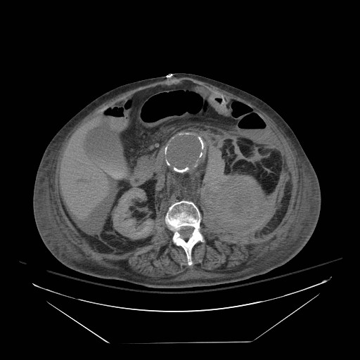 File:Abdominal aortic aneurysm - impending rupture (Radiopaedia 19233-19247 Axial non-contrast 81).jpg