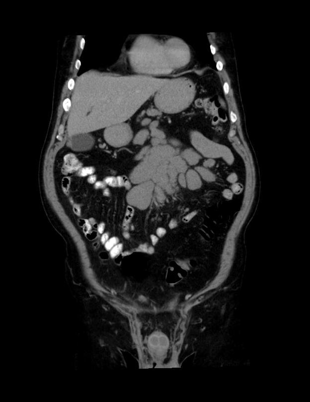 Abdominal lymphoma - with sandwich sign (Radiopaedia 53486-59492 C+ portal venous phase 43).jpg