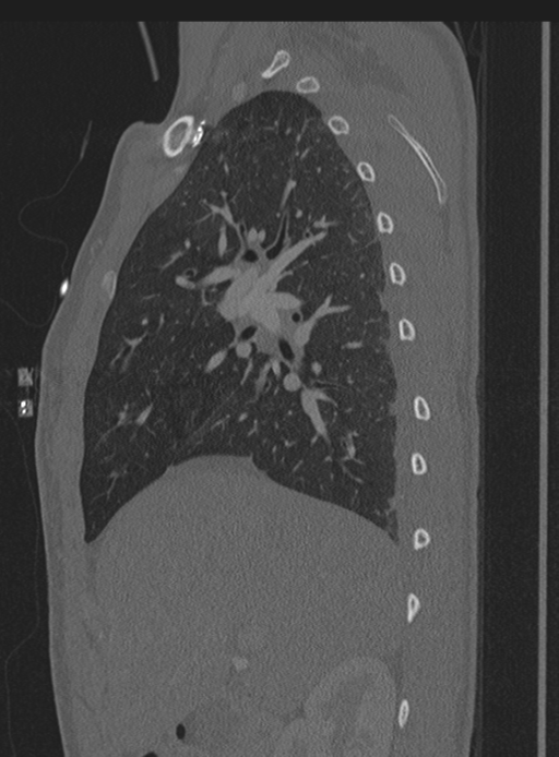 Abdominal multi-trauma - devascularised kidney and liver, spleen and pancreatic lacerations (Radiopaedia 34984-36486 Sagittal bone window 62).png