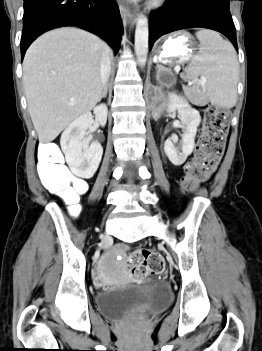 Abdominal wall and retroperitoneal tuberculosis (Radiopaedia 88137-104729 Coronal C+ portal venous phase 63).jpg