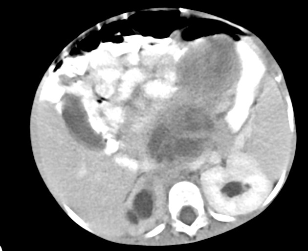 Abdominopelvic rhabdomyosarcoma (Radiopaedia 78356-90984 Axial C+ portal venous phase 68).jpg