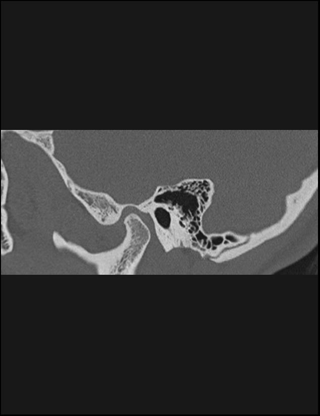 Aberrant right internal carotid artery (Radiopaedia 65191-74198 Sagittal non-contrast 37).jpg