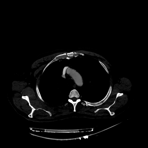 Accesory rib joint (Radiopaedia 71987-82452 Axial bone window 70).jpg
