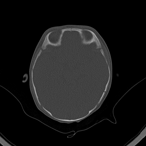 File:Accessory intraparietal suture (Radiopaedia 50584-56020 Axial bone window 16).jpg