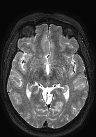 Accessory middle cerebral artery (Radiopaedia 73114-83828 Axial T2 93).jpg