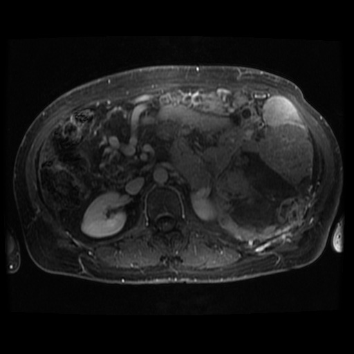File:Acinar cell carcinoma of the pancreas (Radiopaedia 75442-86668 Axial T1 C+ fat sat 43).jpg