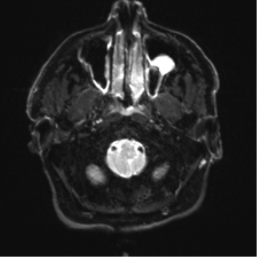 Acoustic schwannoma (Radiopaedia 50846-56358 Axial DWI 2).png